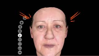 Botox, Filler and Mesotheraphy Simulation Program