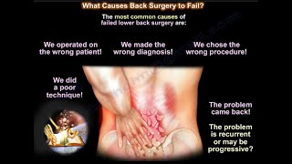 What Causes Back Surgery To Fail ? - Everything You Need To Know - Dr. Nabil Ebraheim