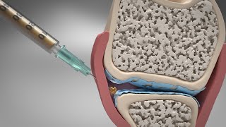 Synovetin OA® MoA Video