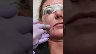 New Laser Skin Resurfacing Device - UltraClear Treatment Demo