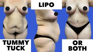 Tummy Tucks vs Liposuction: Which is Right for YOU?