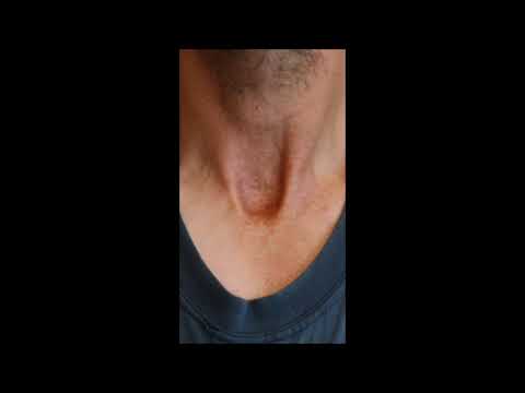 What is a trach scar?