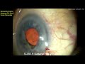 cataractcoach guest surgeon dr luis escaf the ultrachopper for dense cataract surgery