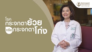 โรคกระจกตาย้วย หรือกระจกตาโก่ง  | โรงพยาบาลบำรุงราษฎร์