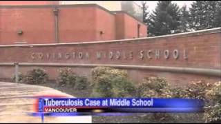 Confirmed case of TB in Vancouver, officials say