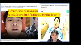 คนดังกับโรค : มดดำ คชาภา กับ เส้นประสาทใบหน้าอักเสบ (  Bell 's Palsy ) แยกกับ Stroke ได้อย่างไร ???