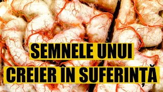 Prof. univ. dr. Alexandru-Vladimir Ciurea: care sunt semnele unui creier în suferință?