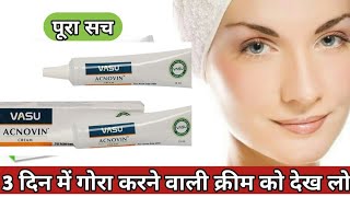 Vasu Acnovin Cream | Ayurvedic Treatment for Acne , Pimple Darkspots,Blackheads l Hindi explanation