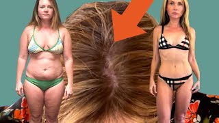 Ozempic weight loss before and after vs Gastric Sleeve: Did Semaglutide Ruin My Hair?