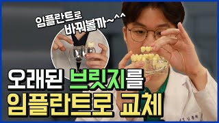 오래된 브릿지를 임플란트로 교체![성남치과]