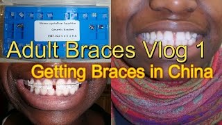 Adult Braces Vlog 1 | Getting Ceramic Braces in China | Ella in China