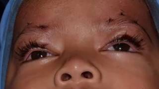 Fascia Lata Eyebrow Suspension in bilateral congenital Ptosis in a 3 years old child