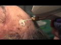 Watch & Learn: Cryosurgery