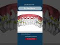 Class III case staging with cutouts for mini screw