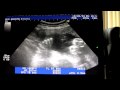 micaiah s 29 week ultrasound