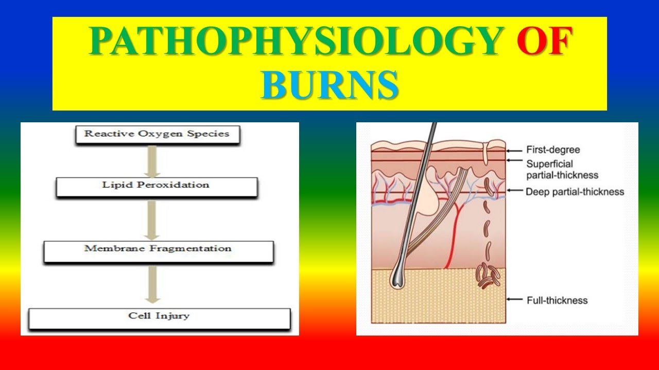 PATHOPHYSIOLOGY OF BURNS - YouTube