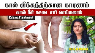 கால் நீர் கட்டு வீக்கத்தை சரி செய்யலாம்| Ankle pain| Edema| Oedema| Swelling| Dr.Nisha #healthtips