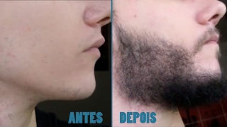 Evolução - Antes e Depois - Minoxidil Kirkland - Barba - 6 Meses.