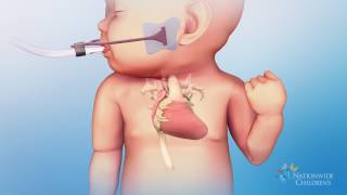 Hypoplastic Left Heart Syndrome (HLHS): Hybrid Stage One Procedure