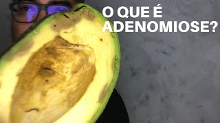 O QUE É ADENOMIOSE, SINTOMAS E POSSÍVEIS CAUSAS