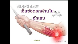 ปวดแขน เอ็นข้อศอกด้านในอักเสบ golfer ‘s elbow โดยนักกายภาพบำบัด