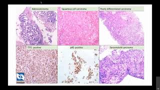 Translational Genomics - Clinical Oncology Research: Dr. Sudha Murthy