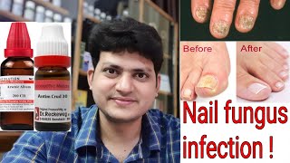 Nail fungus ! Homeopathic Medicine for Nail fungus infection ? Explain Nail fungus ! Homeopathic Medicine for Nail fungus infection ? Explain