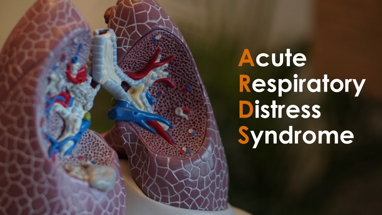 Acute Respiratory Distress Syndrome (ARDS) For USMLE Step1 And USMLE ...