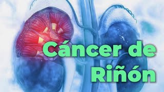 Cáncer de Riñón o Carcinoma Renal: 5 puntos que debes saber, síntomas, riesgos y prevención