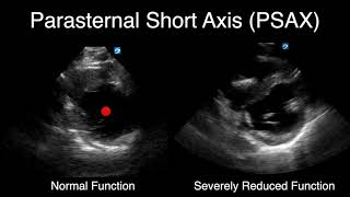 POCUS - Visually Estimating Cardiac Function