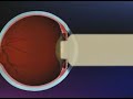 lens insertion procedure at lotus eye hospital india விழிவில்லை செருகும் செயல்பாடு