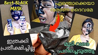 ആഴ്ചയിൽ ഒറ്റ തവണ😱Blckhead,Whitehead മാറ്റാം|Testing\