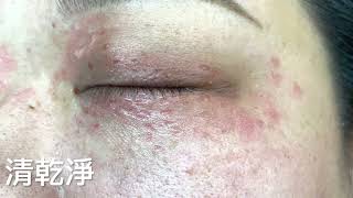 眼周汗管瘤 二氧化碳雷射清除 Syringoma, Eyelid, CO2 laser, Dr George