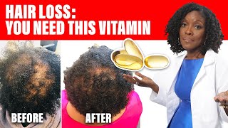 Hair Loss: This Vitamin  Can Save Your Hair
