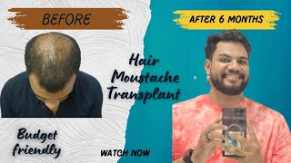 Hair Transplant ചെയുന്നവർക് ഒരു  Best Option 🔥 #hairtransplant #hairtreatment #hairtransformation