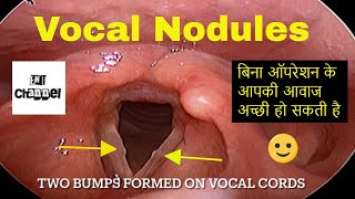 Vocal Nodule | Hoarse Voice | बिना ऑपरेशन ख़राब आवाज़ का ईलाज।