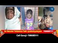 వింత వ్యాధితో పుట్టిన బిడ్డ philippines world hairiest baby due to hypertrichosis mom