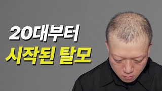 가발? 모자? 이젠 필요 없어진 이유 (40대 탈모 탈출기)