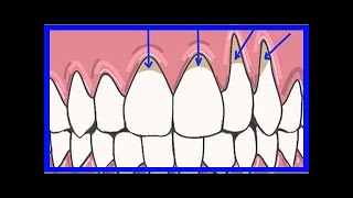 Voici comment soigner vos gencives à la maison