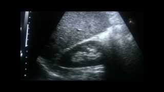 ultrasound REIDELS LOBE of LIVER part 1 of 3