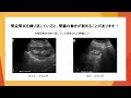 【女性に多い『腎盂腎炎』に関わるお話】膀胱炎＋発熱は要注意？