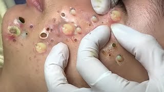 Big Cystic Acne Blackheads Extraction Blackheads \u0026 Milia, Whiteheads Removal Pimple Popping # 8272