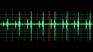 Pulmonary Associated Heart Sounds (PAH)- Split S2