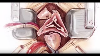 Mini-Bentall Procedure and Hemiarch Replacement: Aortic Aneurysm Resection