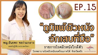 ภูมิแพ้ผิวหนังอักเสบที่มือ (Hand Eczema) | รายการโรคผิวหนังใกล้ตัว EP.15