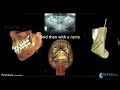 orthognathic jaw surgery u0026 oral and maxillofacial surgery using ct 3d imaging