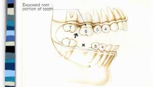 What Happens When a Tooth is Removed