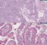 Histopathology Testis--Endodermal sinus tumor (yolk sac tumo