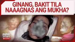 Ginang, bakit tila naaagnas ang mukha? | Public Affairs Exclusives