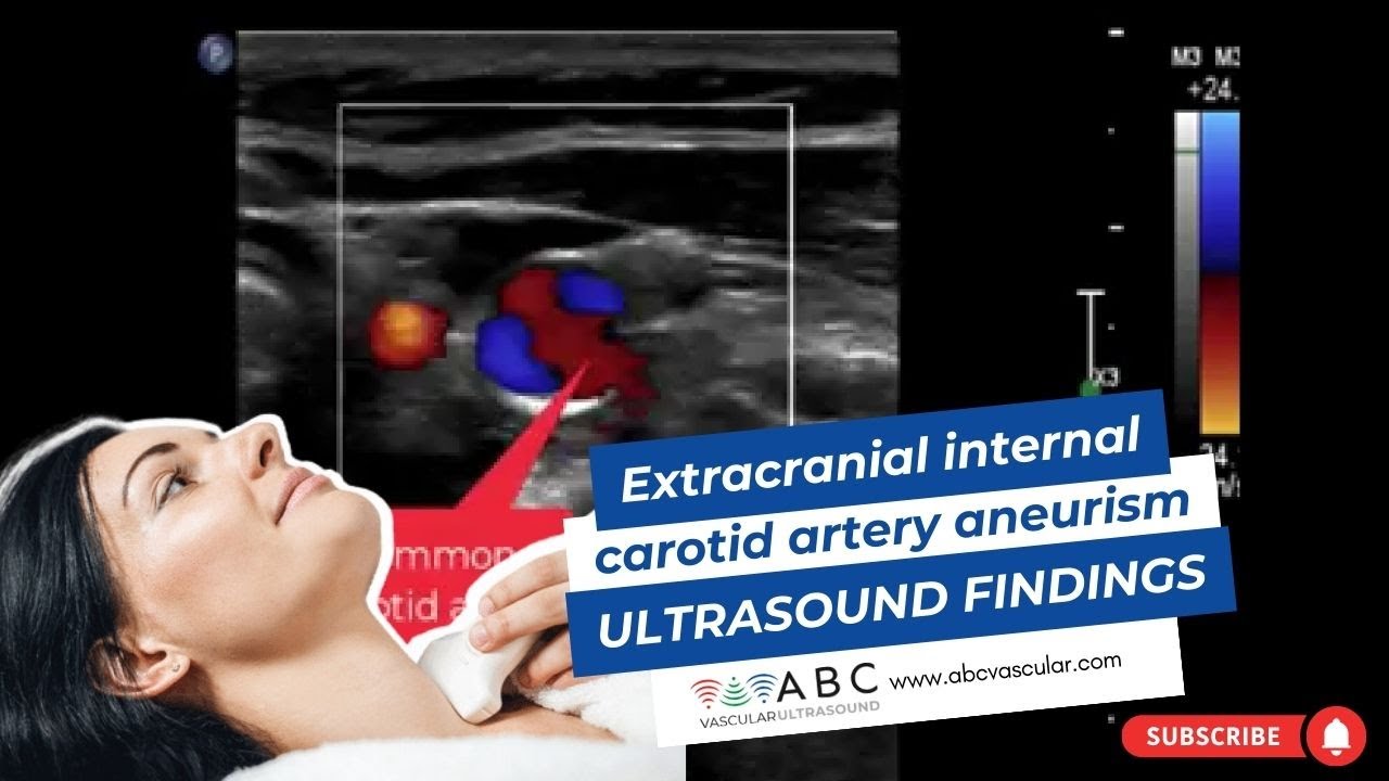 EXTRACRANIAL INTERNAL CAROTID ARTERY ANEURYSM: ULTRASOUND FINDINGS ...